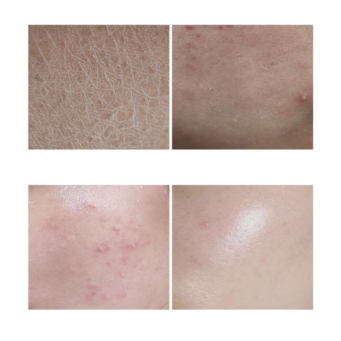 des Wesentlich-30ml reine Rötungs-leuchtende Haut modernes Rosacea 1 Gesichts-des Serum-100%