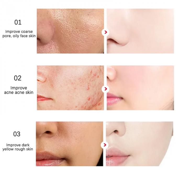 des Wesentlich-30ml reine Rötungs-leuchtende Haut modernes Rosacea 1 Gesichts-des Serum-100%
