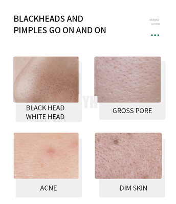 Erweichen Sie Lackhead ableitete Wesentlich-Gesichts-Serum-Mitesser-Entferner-Serum